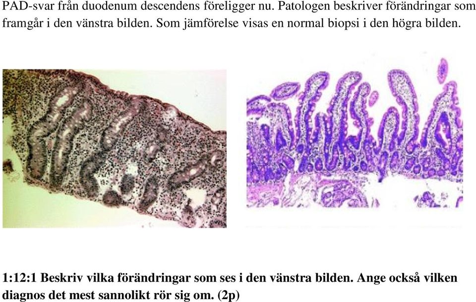 Som jämförelse visas en normal biopsi i den högra bilden.