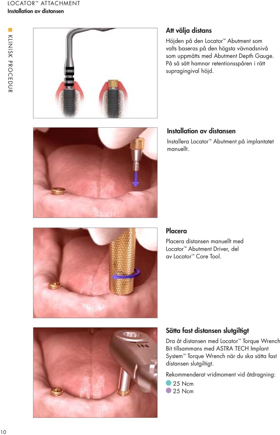 Installation av distansen Installera Locator Abutment på implantatet manuellt.