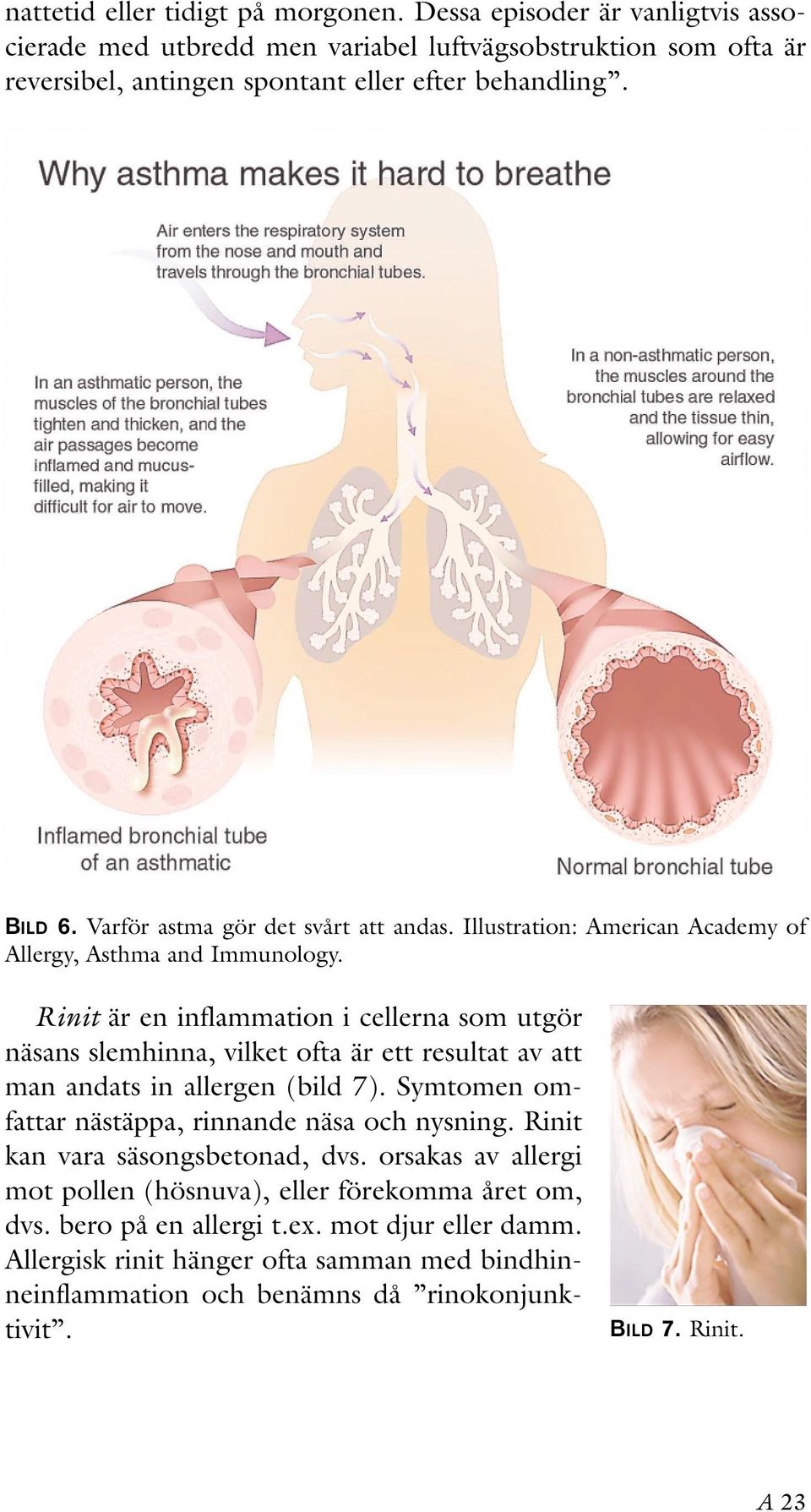 Rinit är en inflammation i cellerna som utgör näsans slemhinna, vilket ofta är ett resultat av att man andats in allergen (bild 7). Symtomen omfattar nästäppa, rinnande näsa och nysning.