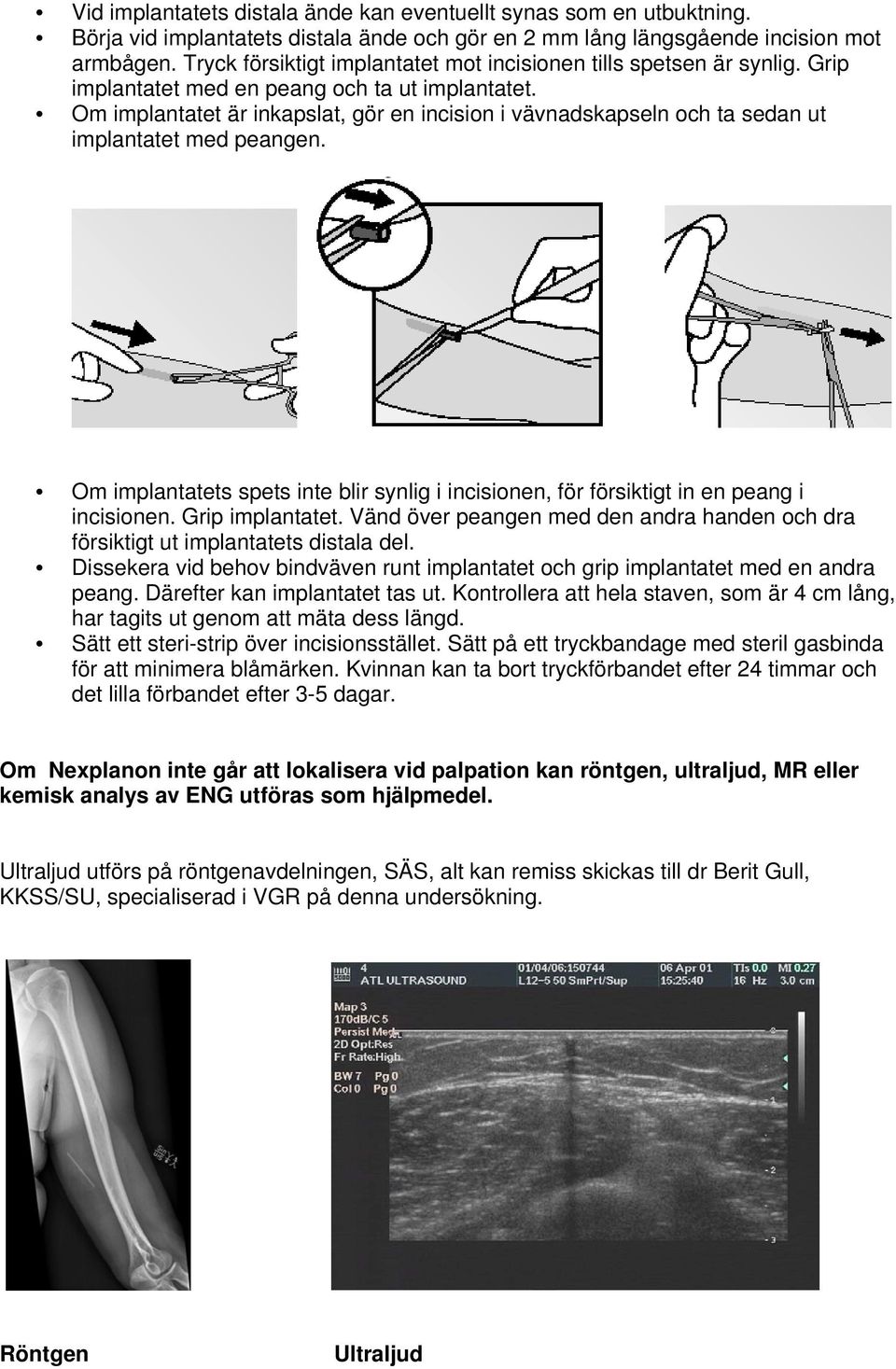 Om implantatet är inkapslat, gör en incision i vävnadskapseln och ta sedan ut implantatet med peangen. Om implantatets spets inte blir synlig i incisionen, för försiktigt in en peang i incisionen.