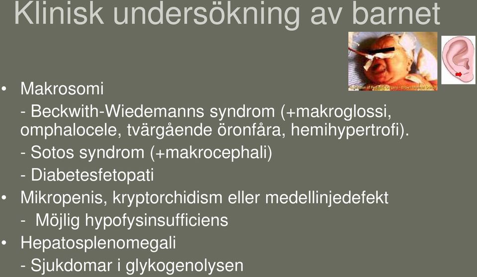 - Sotos syndrom (+makrocephali) - Diabetesfetopati Mikropenis, kryptorchidism