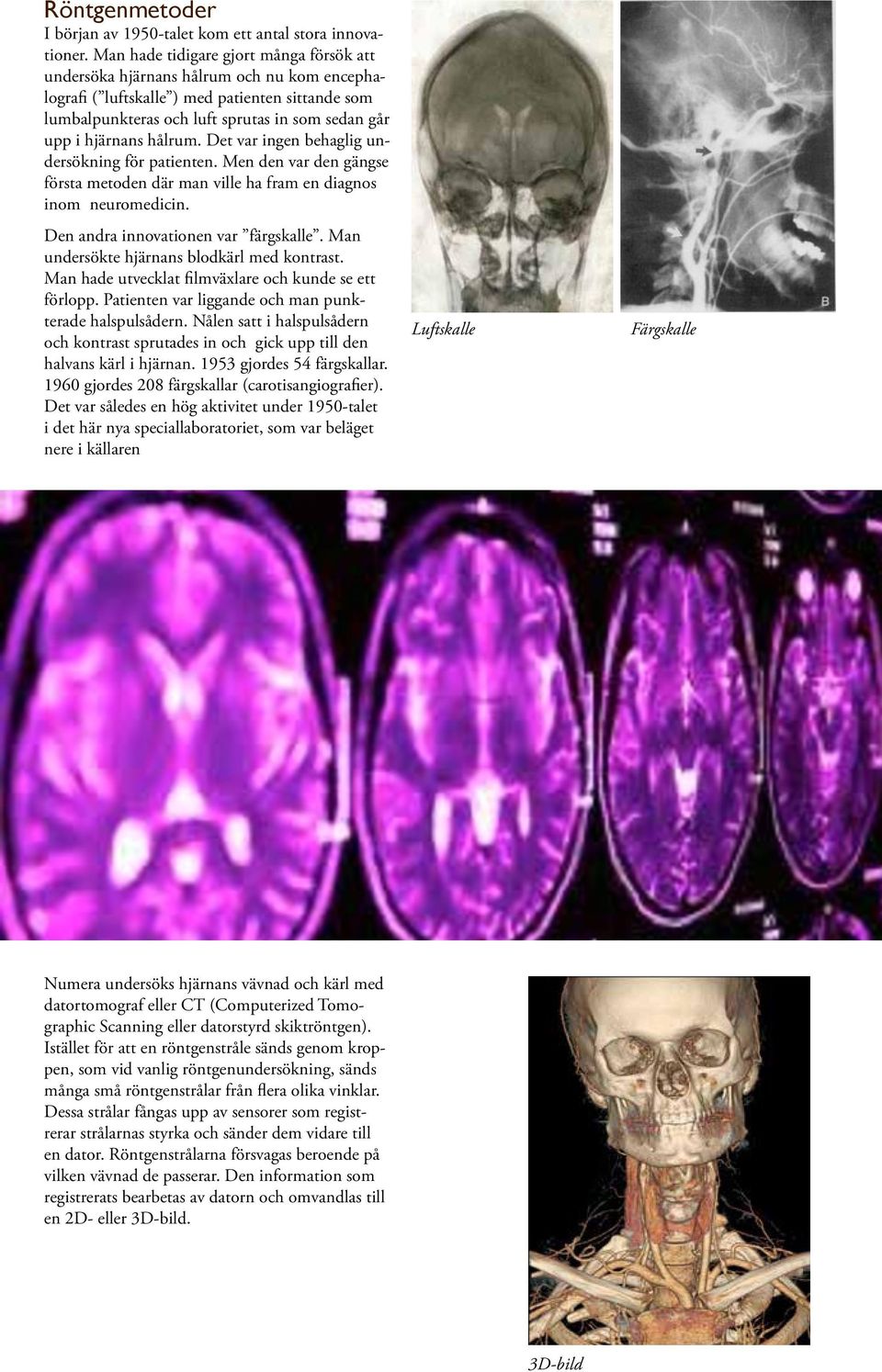 hålrum. Det var ingen behaglig undersökning för patienten. Men den var den gängse första metoden där man ville ha fram en diagnos inom neuromedicin. Den andra innovationen var färgskalle.