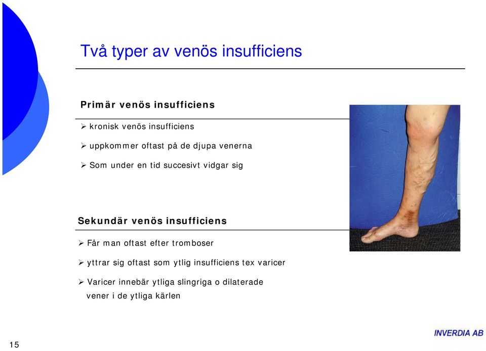 venös insufficiens Får man oftast efter tromboser yttrar sig oftast som ytlig
