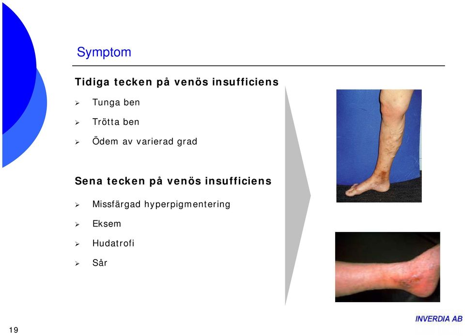 varierad grad Sena tecken på venös