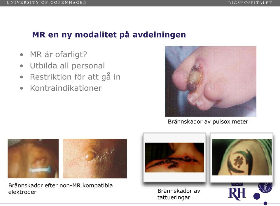 Kontraindikationer Brännskador av pulsoximeter