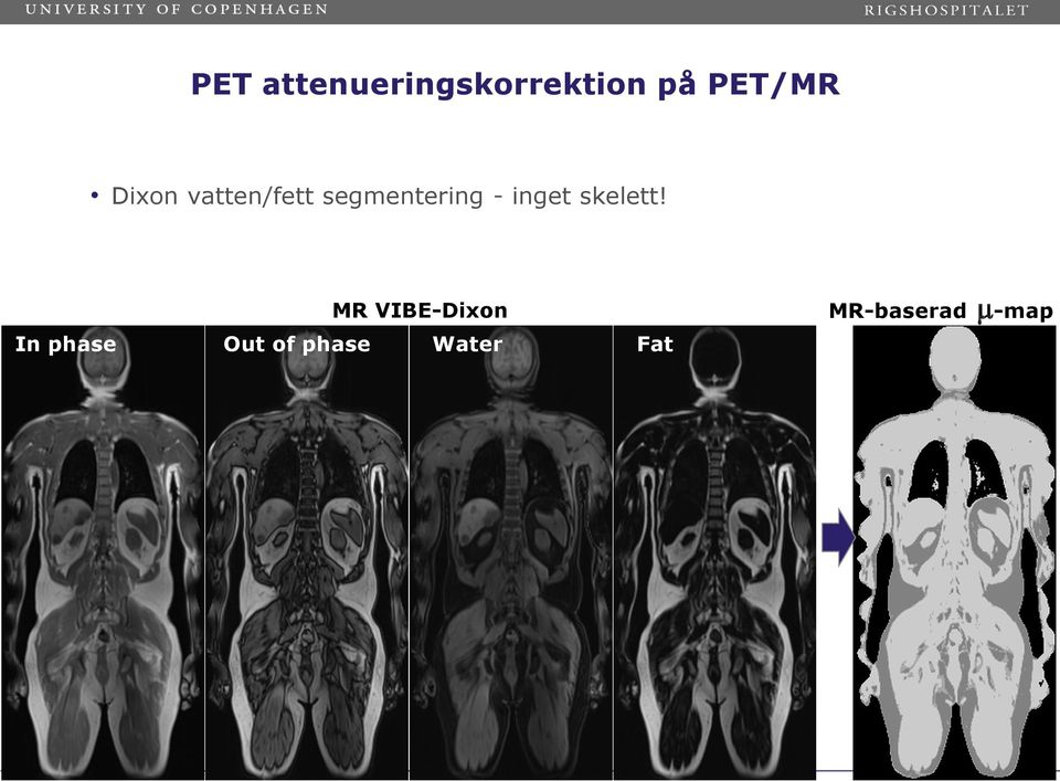 In-phase MR VIBE-Dixon Opposite-phase In phase