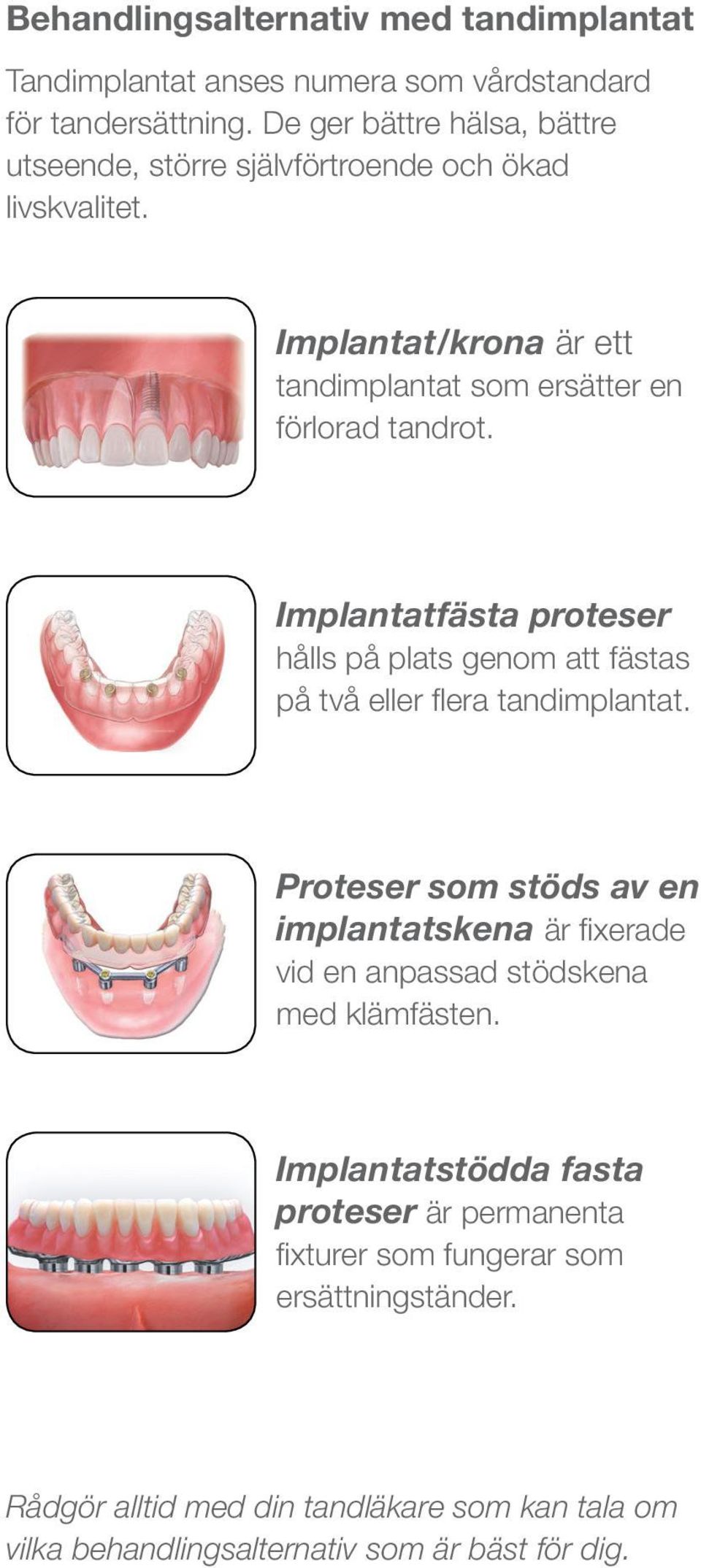 Implantatfästa proteser hålls på plats genom att fästas på två eller flera tandimplantat.