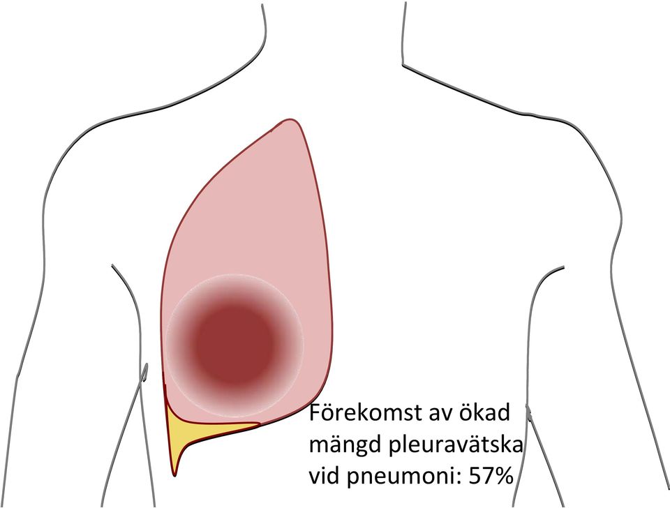 pleuravätska