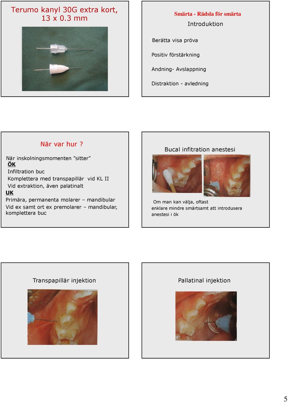 hur? När inskolningsmomenten sitter ÖK Infiltration buc Komplettera med transpapillär vid KL II Vid extraktion, även palatinalt UK