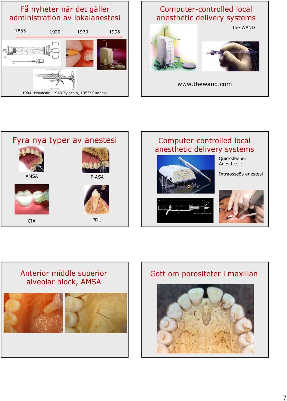 com 1904: Novocain, 1943 Xylocain, 1953: Citanest Fyra nya typer av anestesi Computer-controlled local