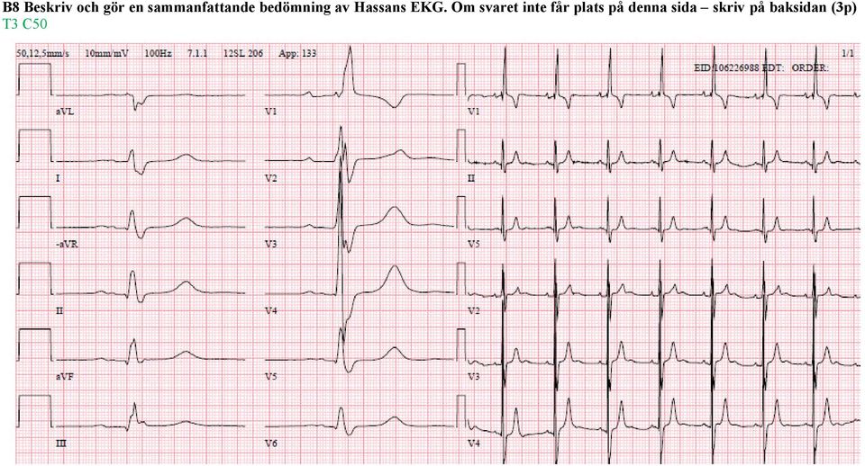 Hassans EKG.