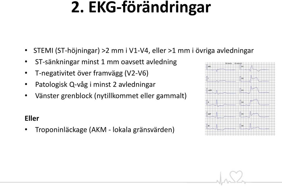 över framvägg (V2-V6) Patologisk Q-våg i minst 2 avledningar Vänster