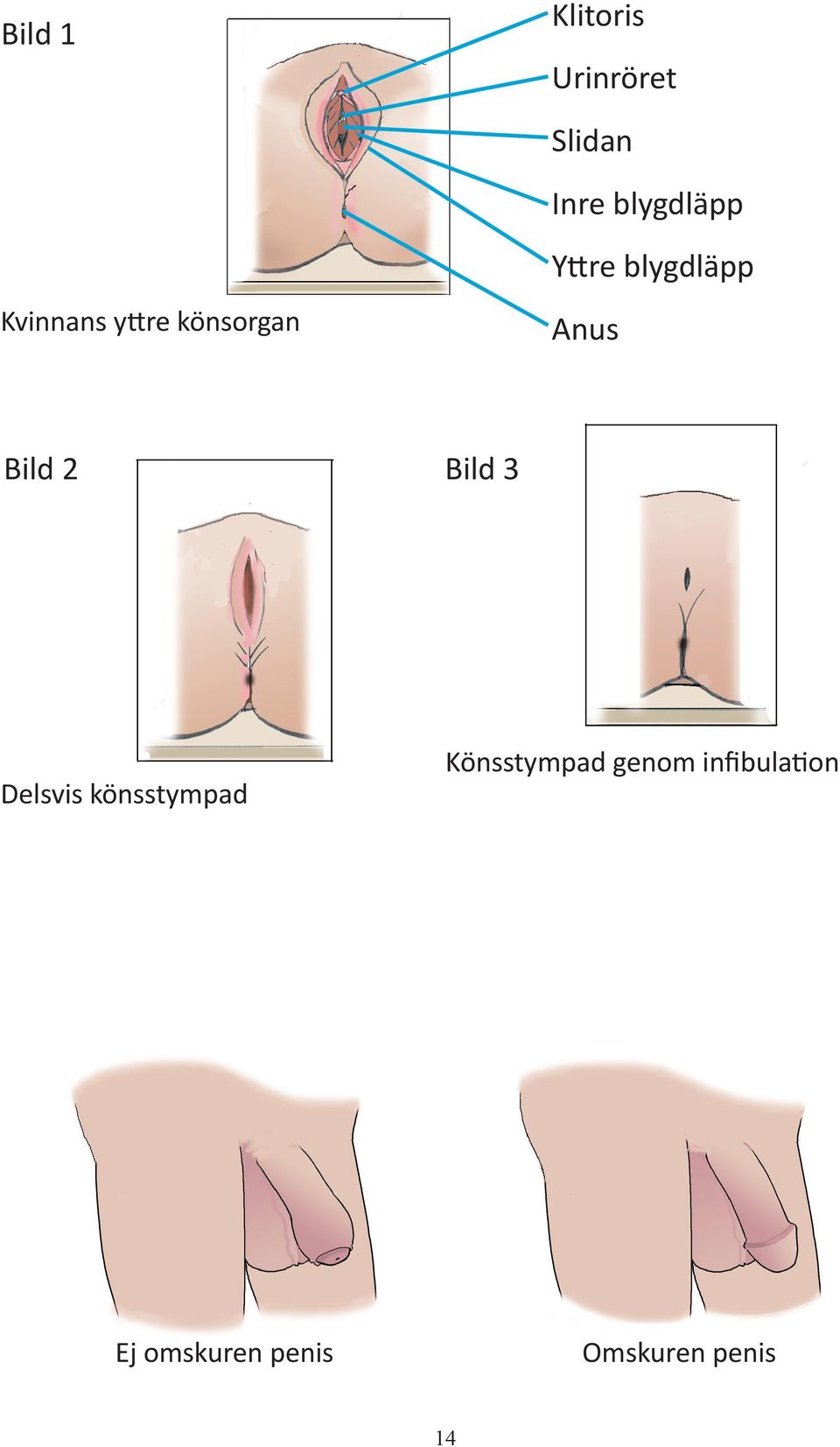 Bild 2 Bild 3 Delsvis könsstympad Könsstympad