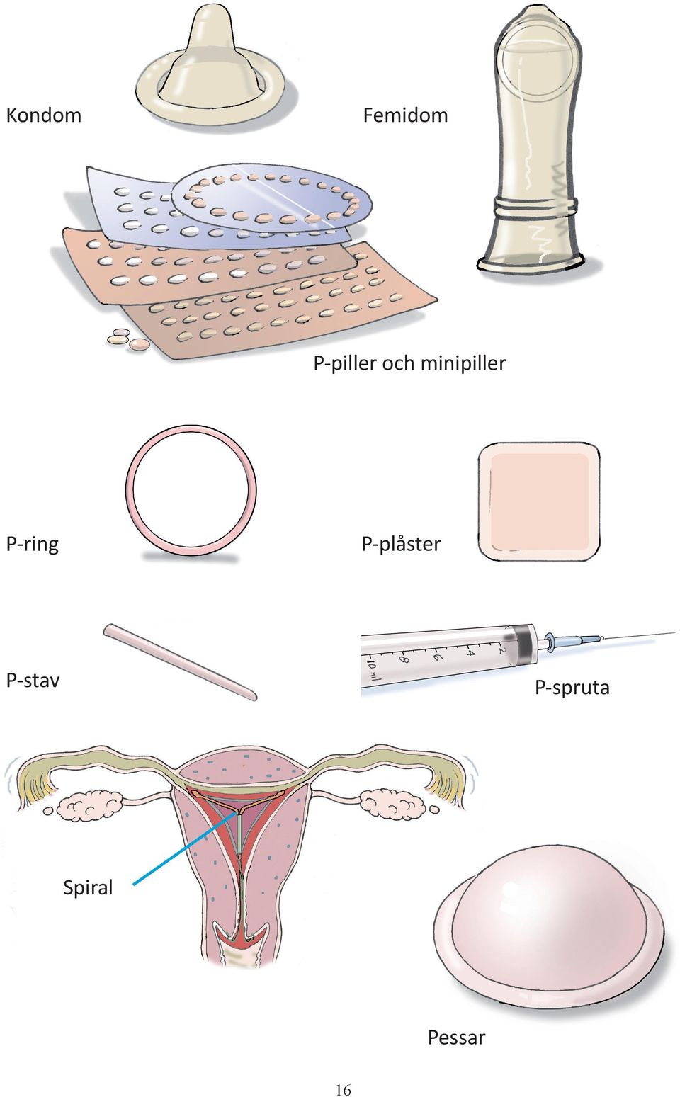 minipiller P-ring