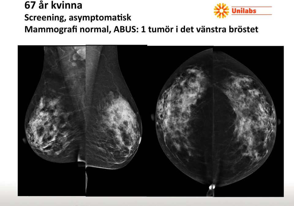 normal, ABUS: 1 tumör i