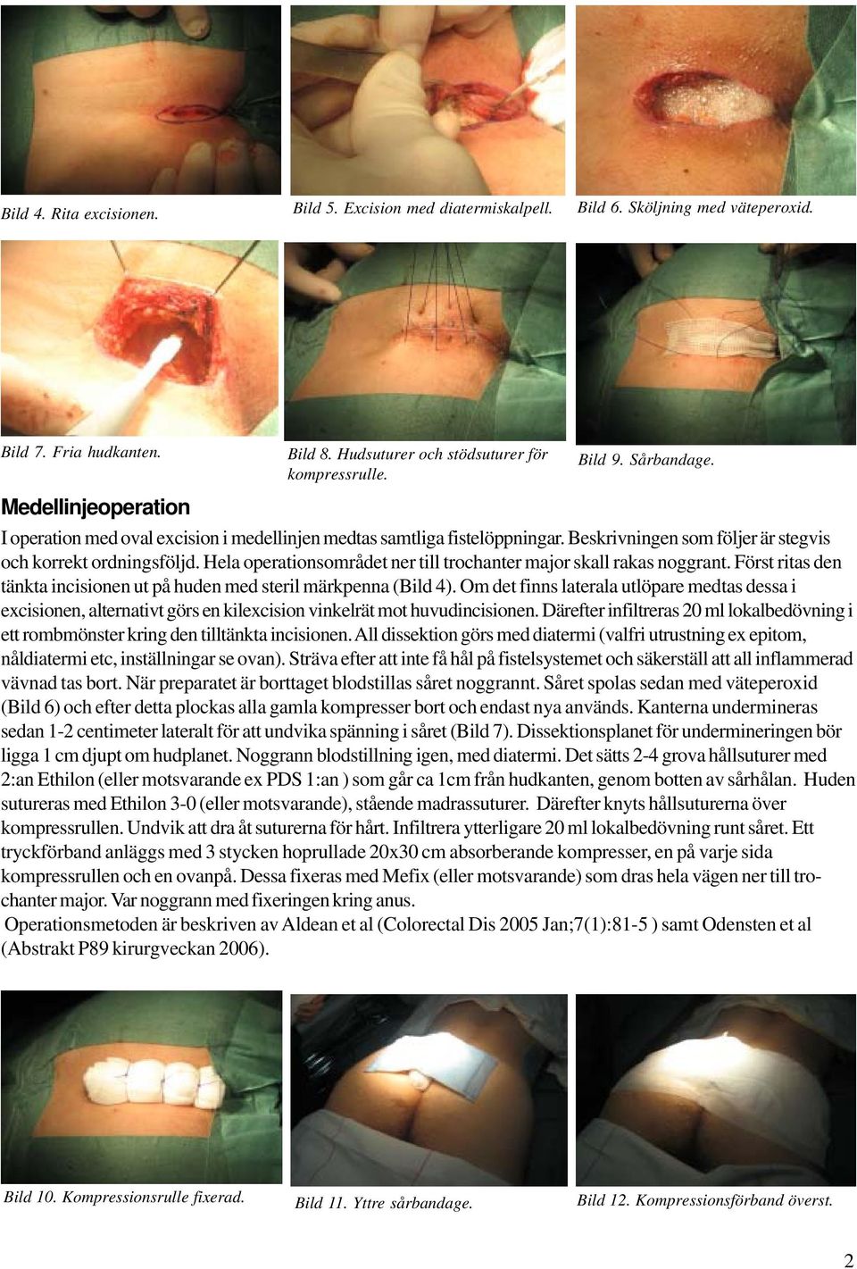 Hela operationsområdet ner till trochanter major skall rakas noggrant. Först ritas den tänkta incisionen ut på huden med steril märkpenna (Bild 4).