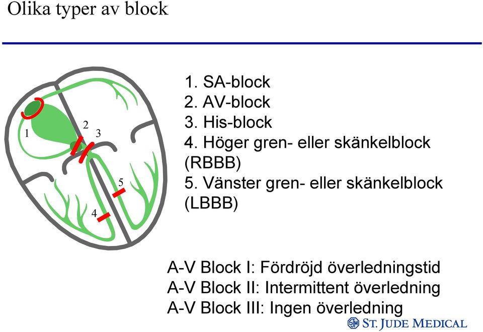 Vänster gren- eller skänkelblock (LBBB) A-V Block I: Fördröjd