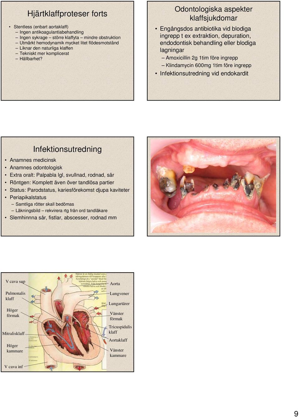 Odontologiska aspekter klaffsjukdomar Engångsdos antibiotika vid blodiga ingrepp t ex extraktion, depuration, endodontisk behandling eller blodiga lagningar Amoxicillin 2g 1tim före ingrepp