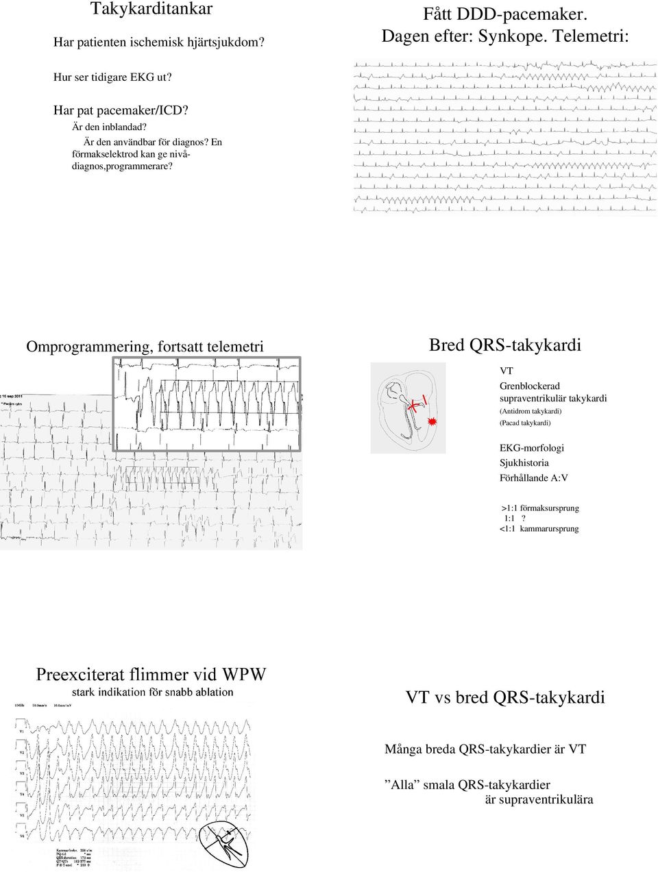 Omprogrammering, fortsatt telemetri Bred QRS-takykardi VT Grenblockerad supraventrikulär takykardi (Antidrom takykardi) (Pacad takykardi)