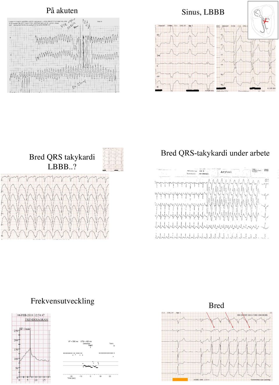 takykardi LBBB.