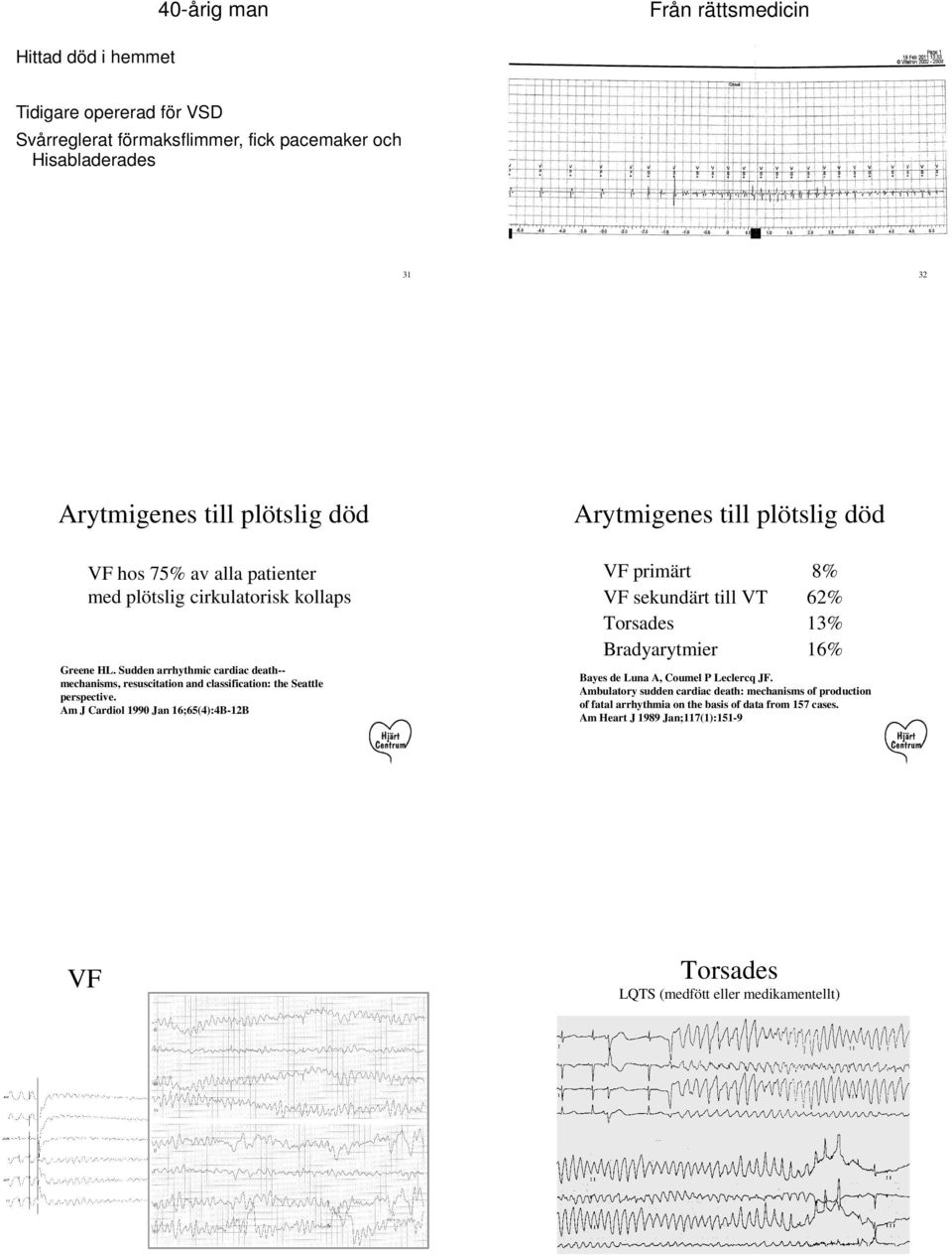 Am J Cardiol 1990 Jan 16;65(4):4B-12B 32 Arytmigenes till plötslig död VF primärt VF sekundärt till VT Torsades Bradyarytmier 8% 62% 13% 16% Bayes de Luna A, Coumel P Leclercq JF.