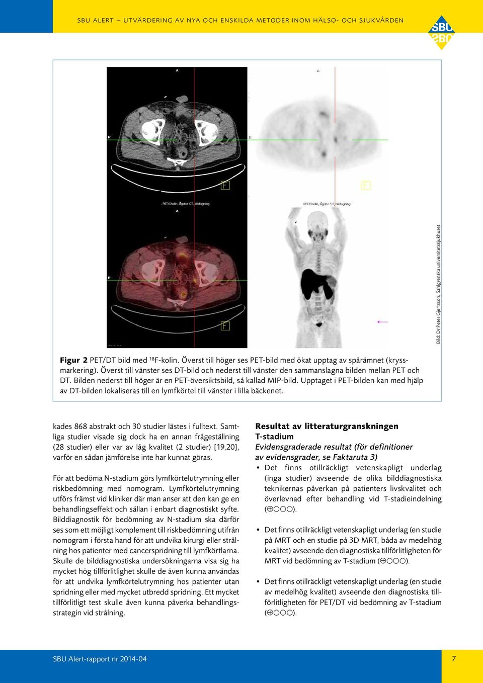 Upptaget i PET-bilden kan med hjälp av DT-bilden lokaliseras till en lymfkörtel till vänster i lilla bäckenet. kades 868 abstrakt och 30 studier lästes i fulltext.