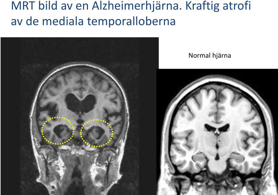 Kraftig atrofi av de