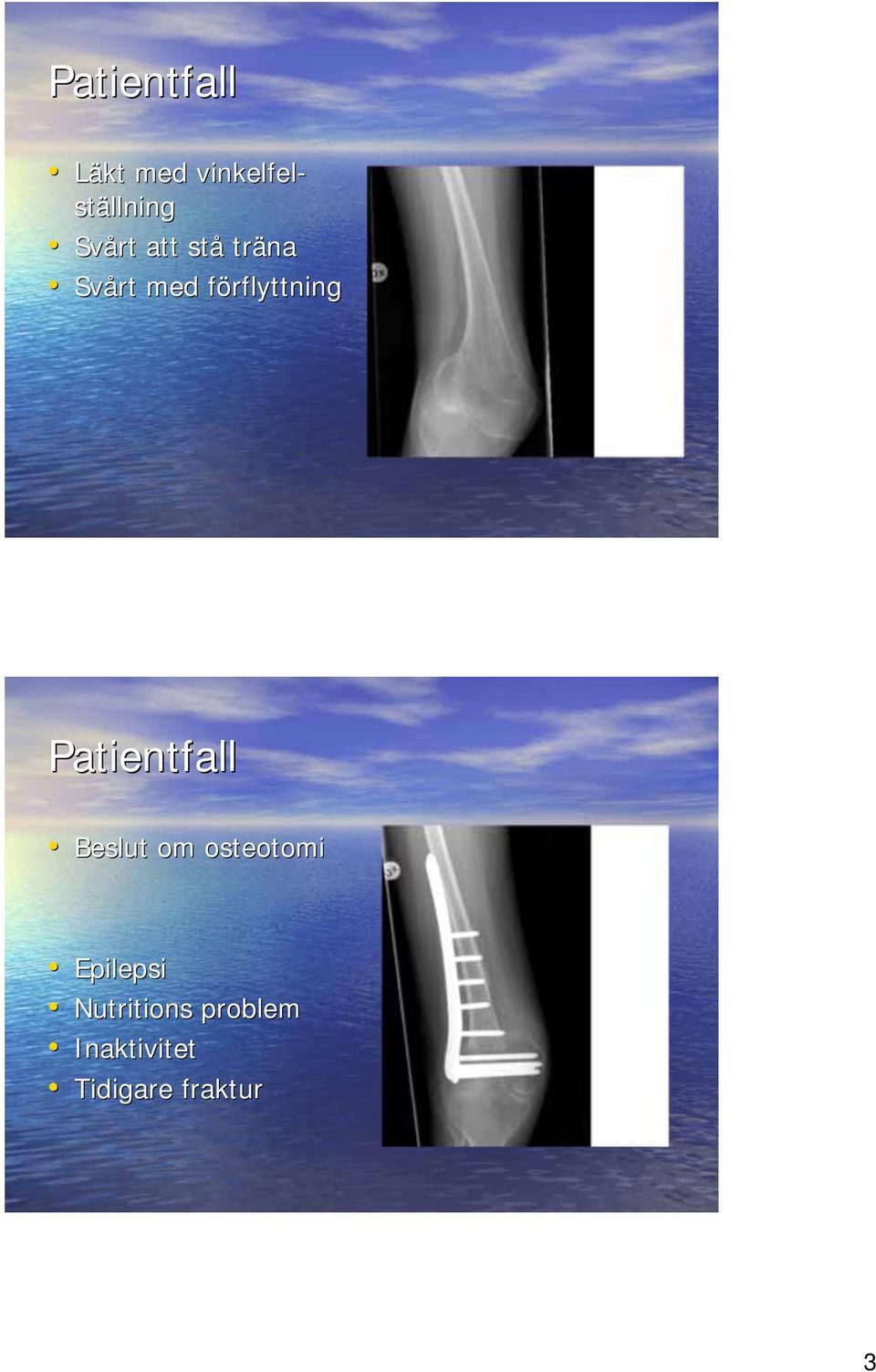 Patientfall Beslut om osteotomi Epilepsi