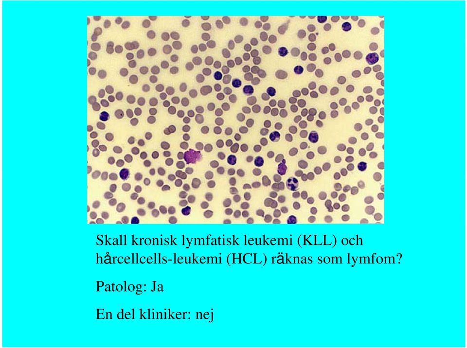 hårcellcells-leukemi (HCL)