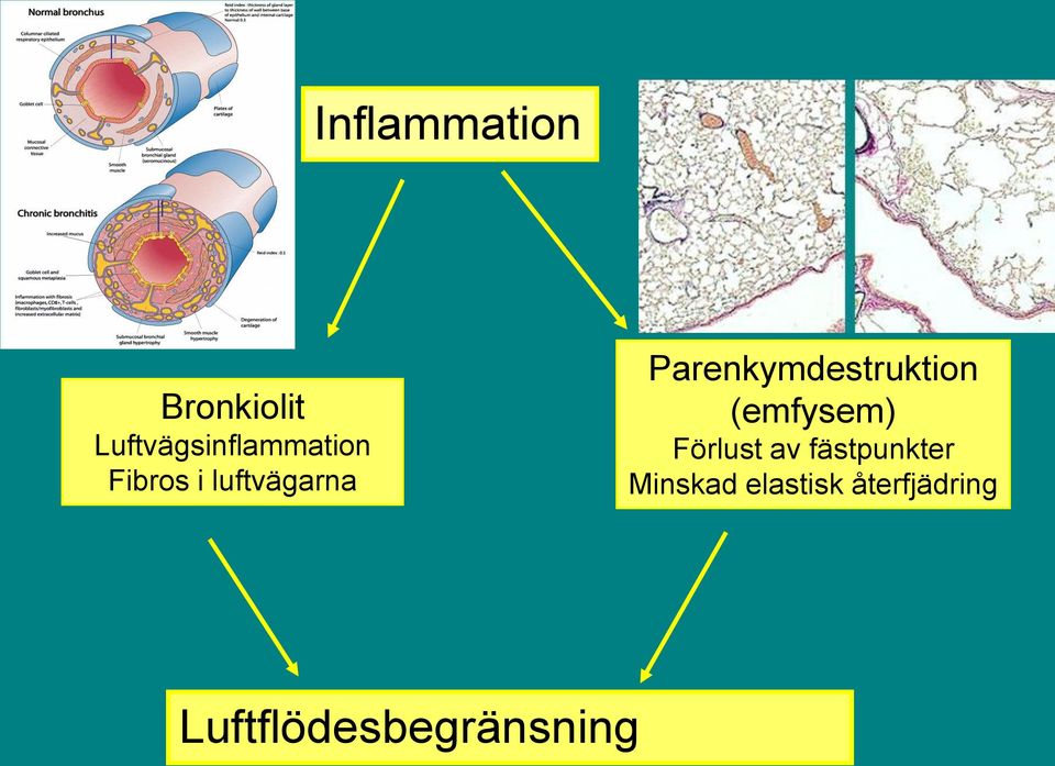 Parenkymdestruktion (emfysem) Förlust av