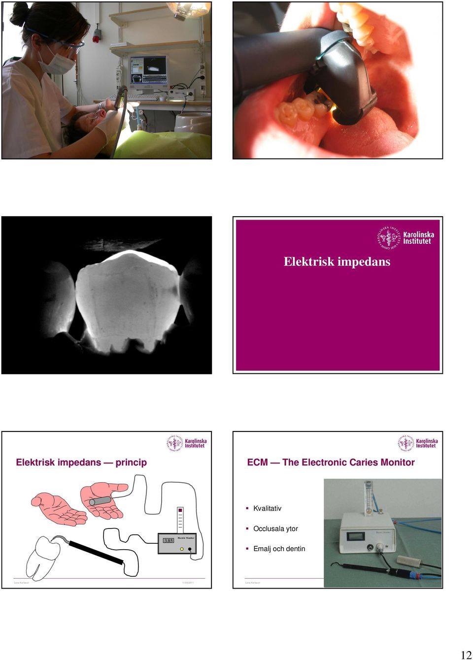 Caries Monitor Kvalitativ 3.