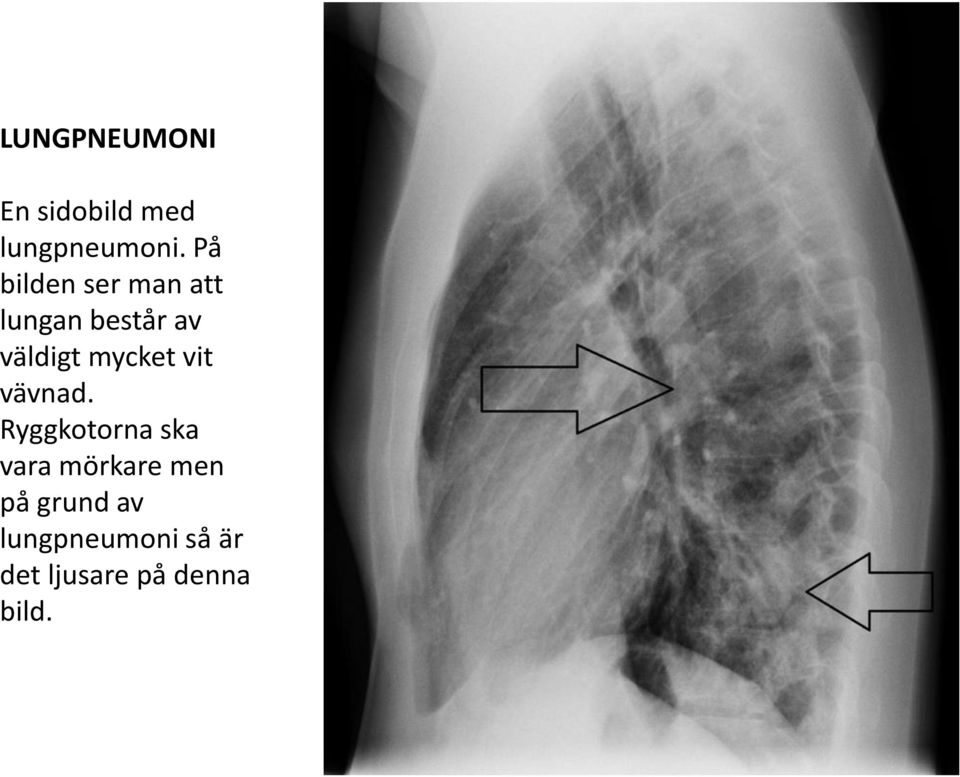 mycket vit vävnad.