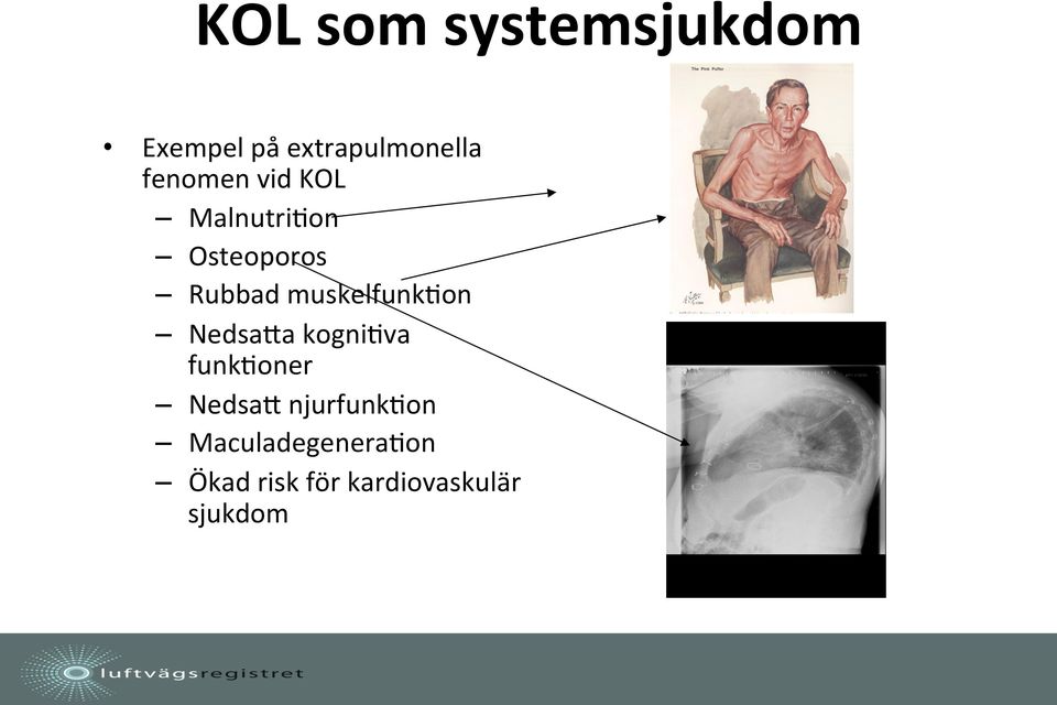 muskelfunkgon NedsaPa kognigva funkgoner NedsaP