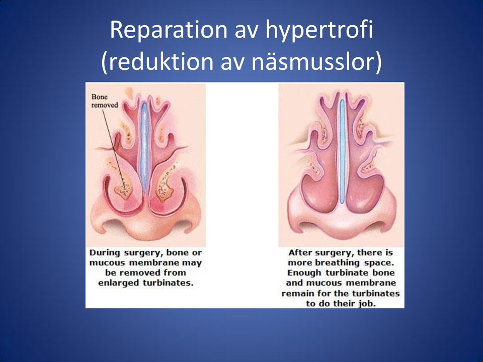 hypertrofi