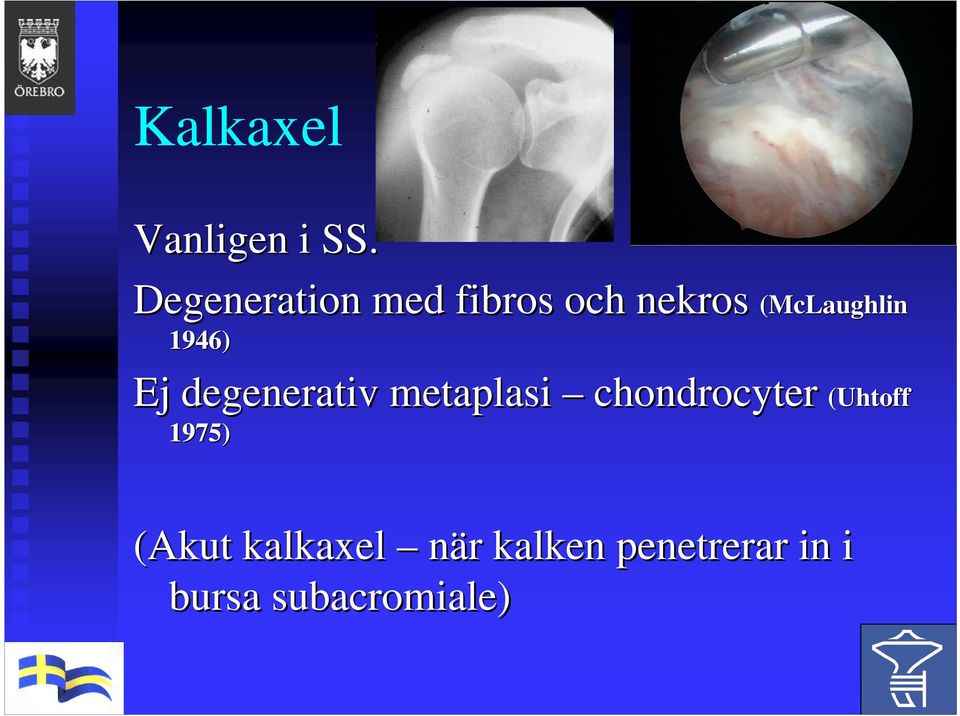 (McLaughlin Ej degenerativ metaplasi chondrocyter