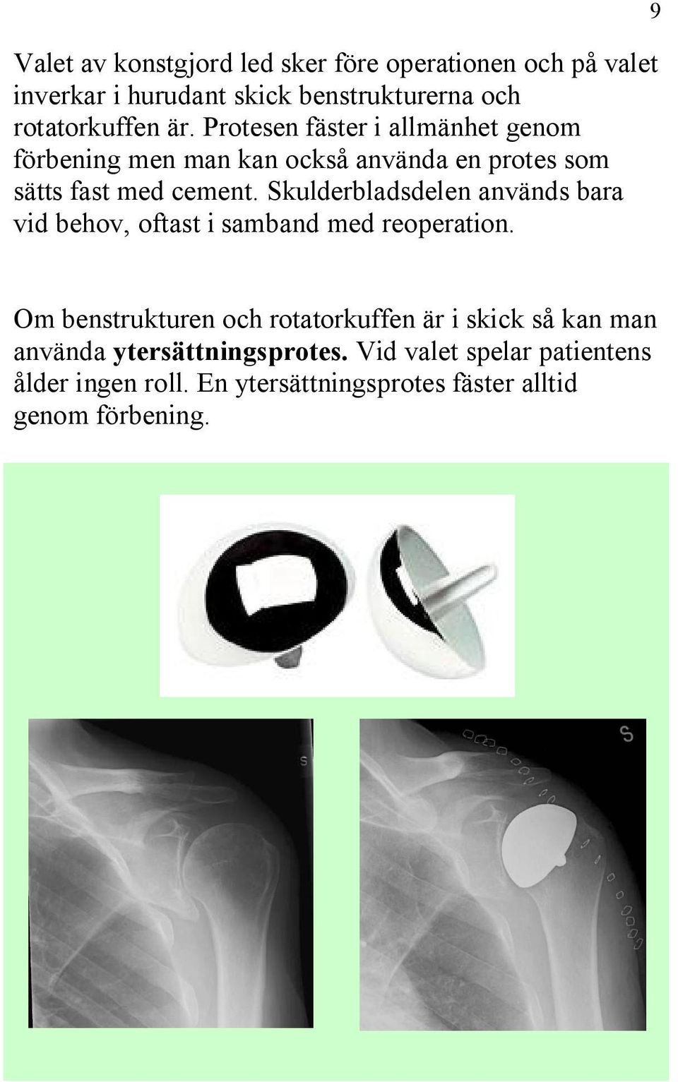 Skulderbladsdelen används bara vid behov, oftast i samband med reoperation.