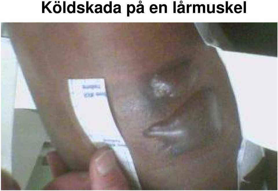 lårmuskel