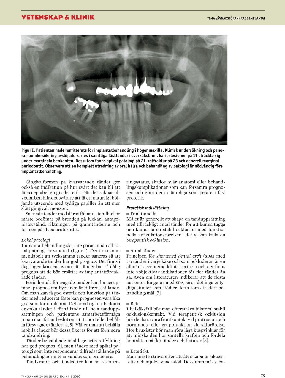 Dessutom fnns pikl ptologi på 21, rotfrktur på 23 oh generell mrginl periodontit. Oserver tt en komplett utredning v orl häls oh ehndling v ptologi är nödvändig före implnttehndling.