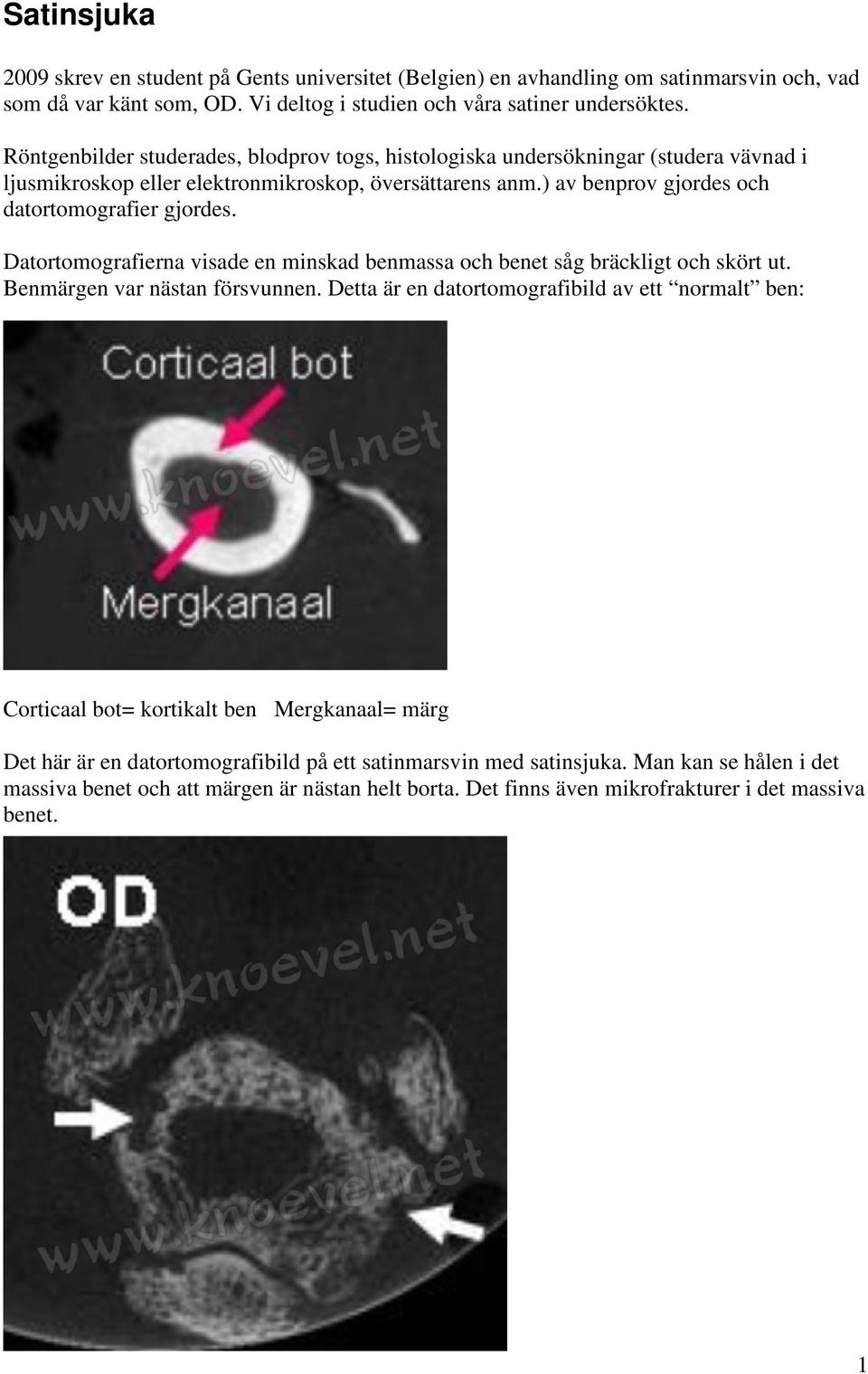 Datortomografierna visade en minskad benmassa och benet såg bräckligt och skört ut. Benmärgen var nästan försvunnen.