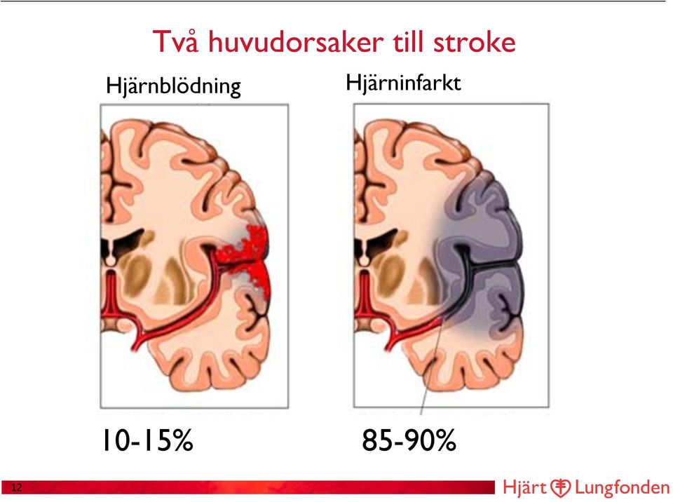 Hjärnblödning