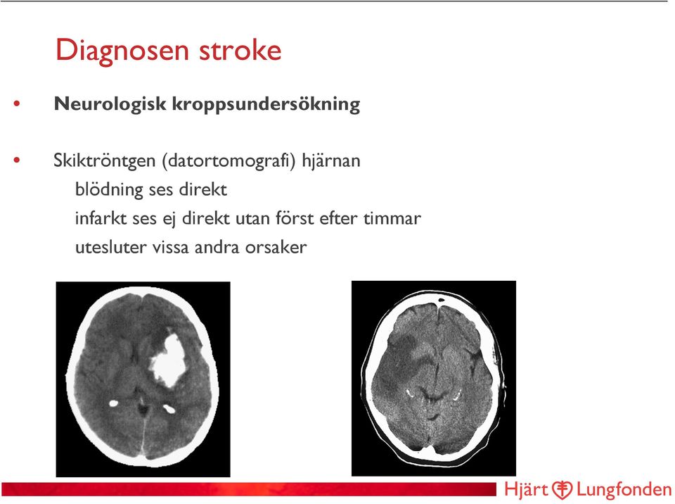 (datortomografi) hjärnan blödning ses direkt