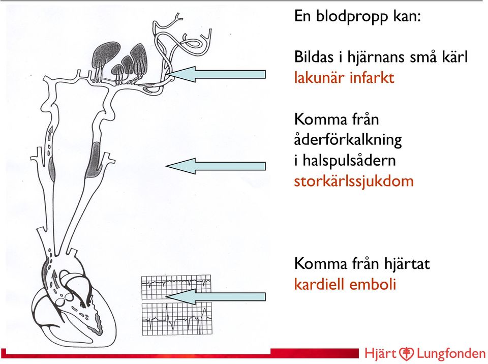 åderförkalkning i halspulsådern