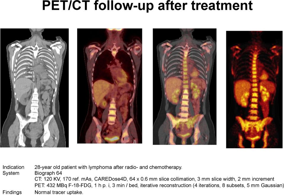 6 mm slice collimation, 3 mm slice width, 2 mm increment PET: 432 MBq F-18-FDG, 1 h p.