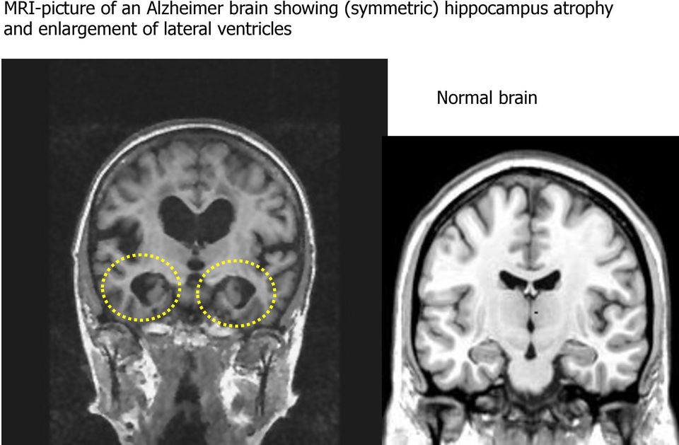 hippocampus atrophy and