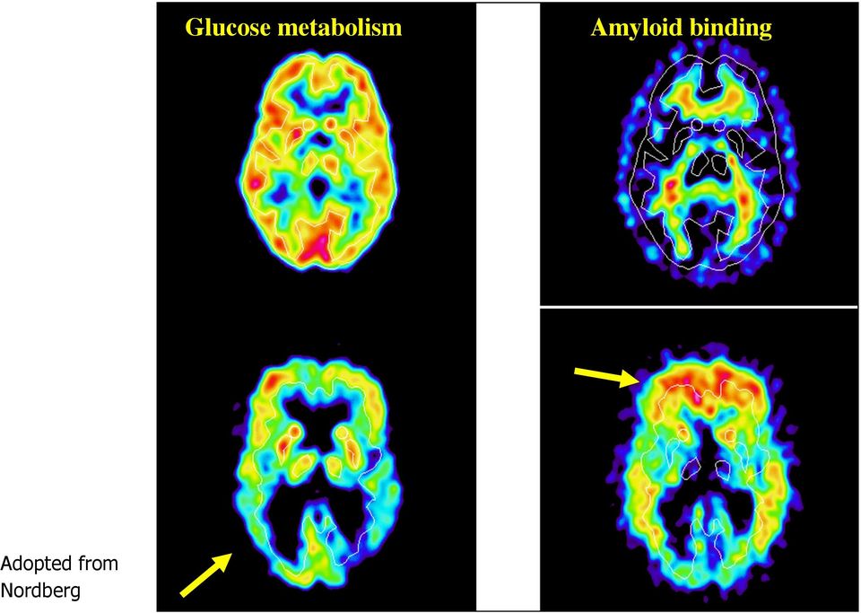 Control Alzheimer