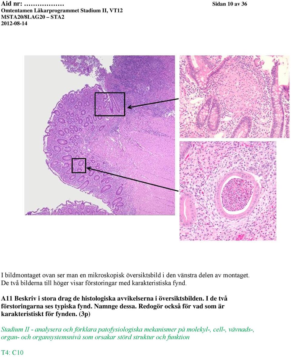 A11 Beskriv i stora drag de histologiska avvikelserna i översiktsbilden. I de två förstoringarna ses typiska fynd. Namnge dessa.