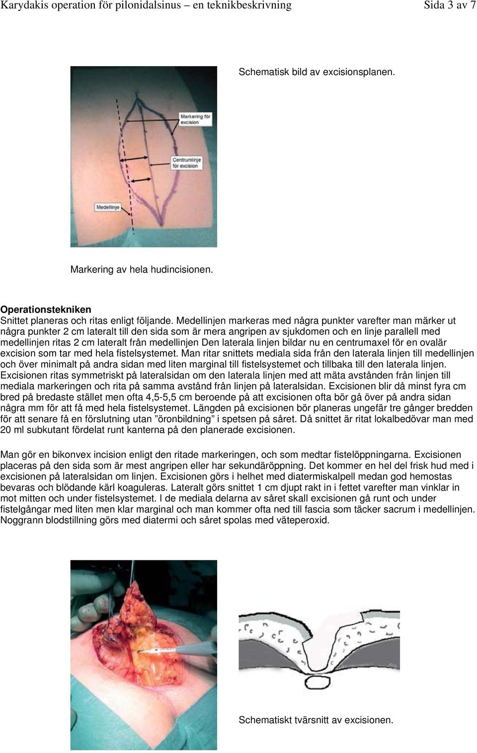 från medellinjen Den laterala linjen bildar nu en centrumaxel för en ovalär excision som tar med hela fistelsystemet.