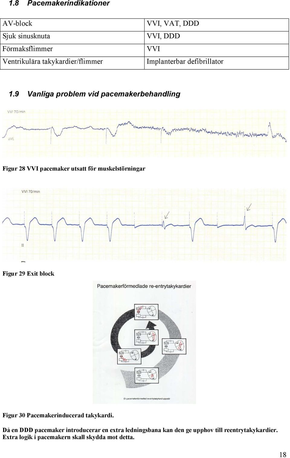 9 Vanliga problem vid pacemakerbehandling Figur 28 VVI pacemaker utsatt för muskelstörningar Figur 29 Exit block