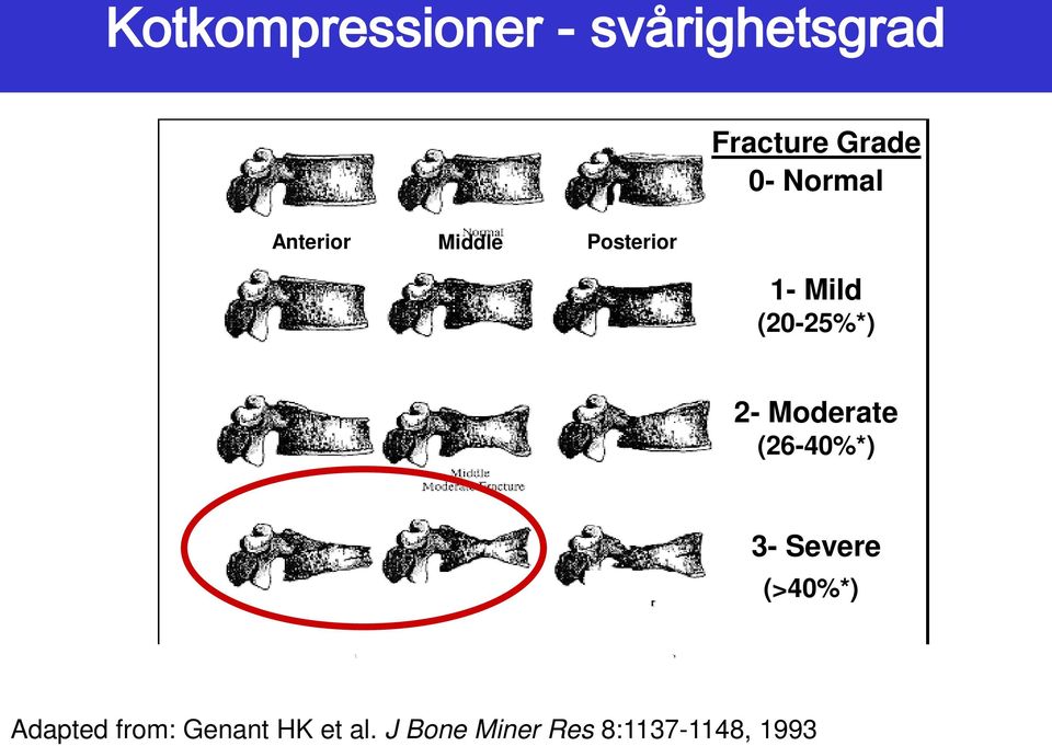 2- Moderate (26-40%*) 3- Severe (>40%*) Adapted