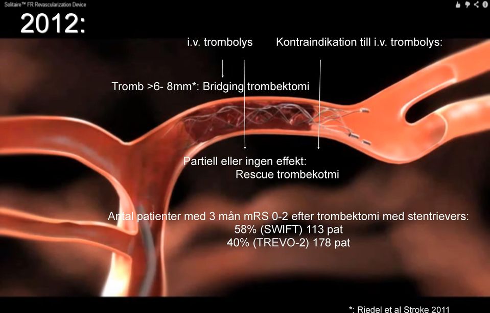 trombolys: Tromb >6-8mm*: Bridging trombektomi Partiell eller ingen